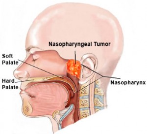 Obat Kanker Nasofaring